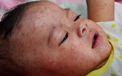 Dozens of kids are catching measles in Ohio