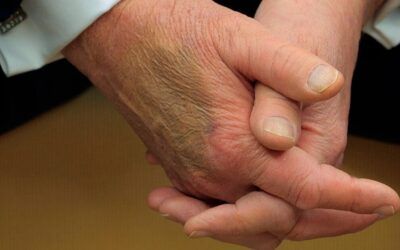 White House explains bruising on Trump’s hand